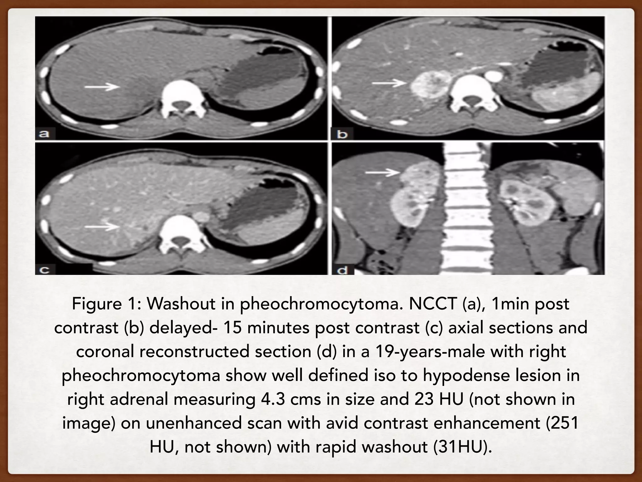 Figure 1: Washout in pheochromocytoma. NCCT (a), 1min post
contrast (b) delayed- 15 minutes post contrast (c) axial sections and
coronal reconstructed section (d) in a 19-years-male with right
pheochromocytoma show well defined iso to hypodense lesion in
right adrenal measuring 4.3 cms in size and 23 HU (not shown in
image) on unenhanced scan with avid contrast enhancement (251
HU, not shown) with rapid washout (31HU).
 