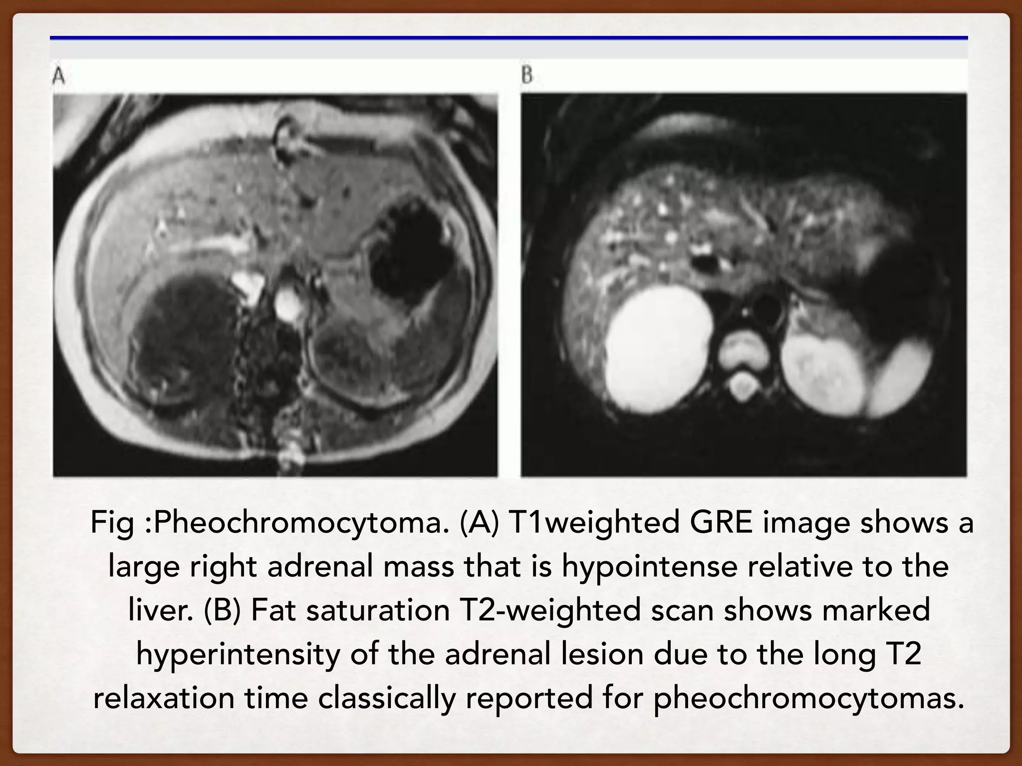 Fig :Pheochromocytoma. (A) T1weighted GRE image shows a
large right adrenal mass that is hypointense relative to the
liver. (B) Fat saturation T2-weighted scan shows marked
hyperintensity of the adrenal lesion due to the long T2
relaxation time classically reported for pheochromocytomas.
 