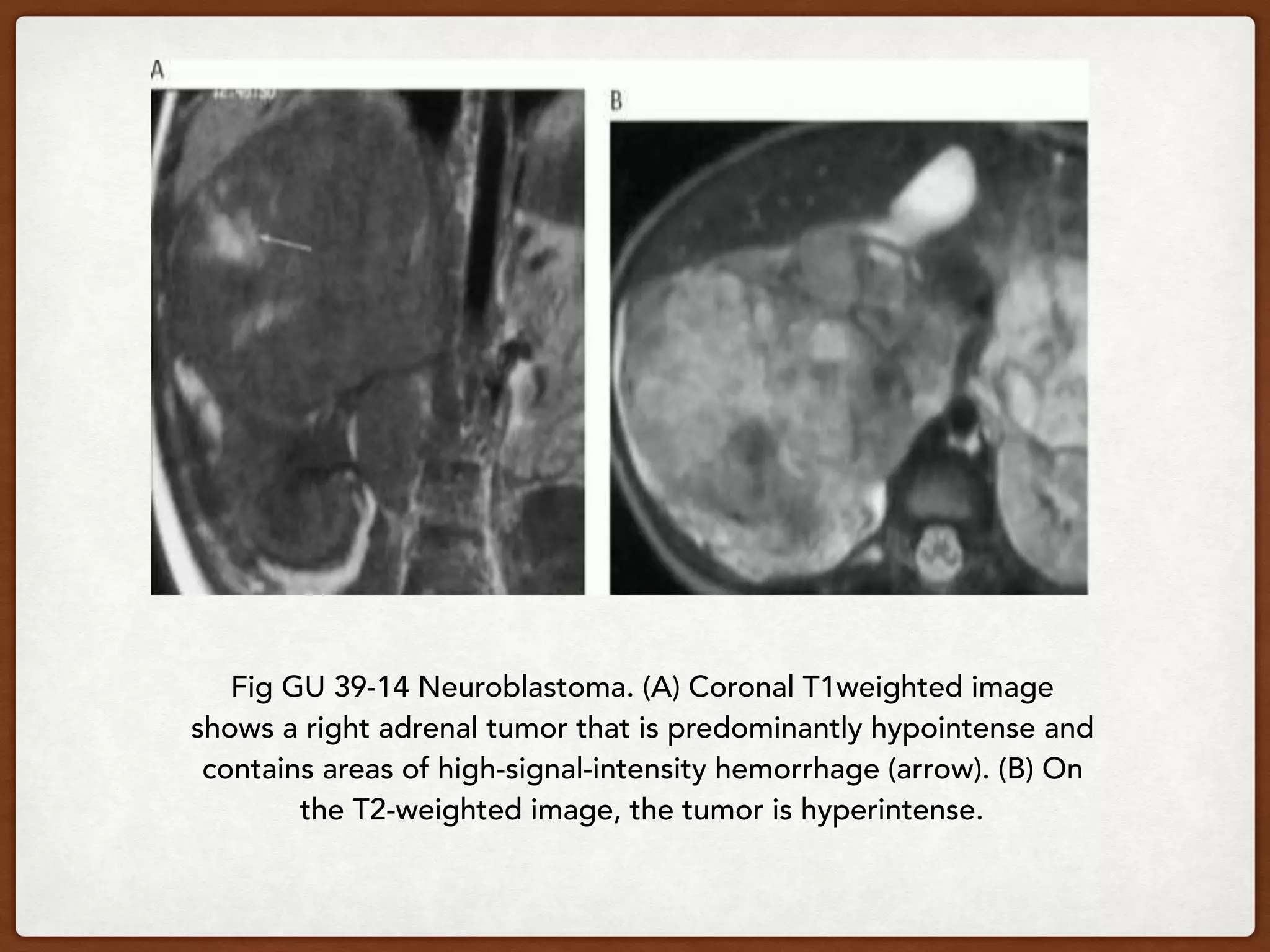 Fig GU 39-14 Neuroblastoma. (A) Coronal T1weighted image
shows a right adrenal tumor that is predominantly hypointense and
contains areas of high-signal-intensity hemorrhage (arrow). (B) On
the T2-weighted image, the tumor is hyperintense.
 