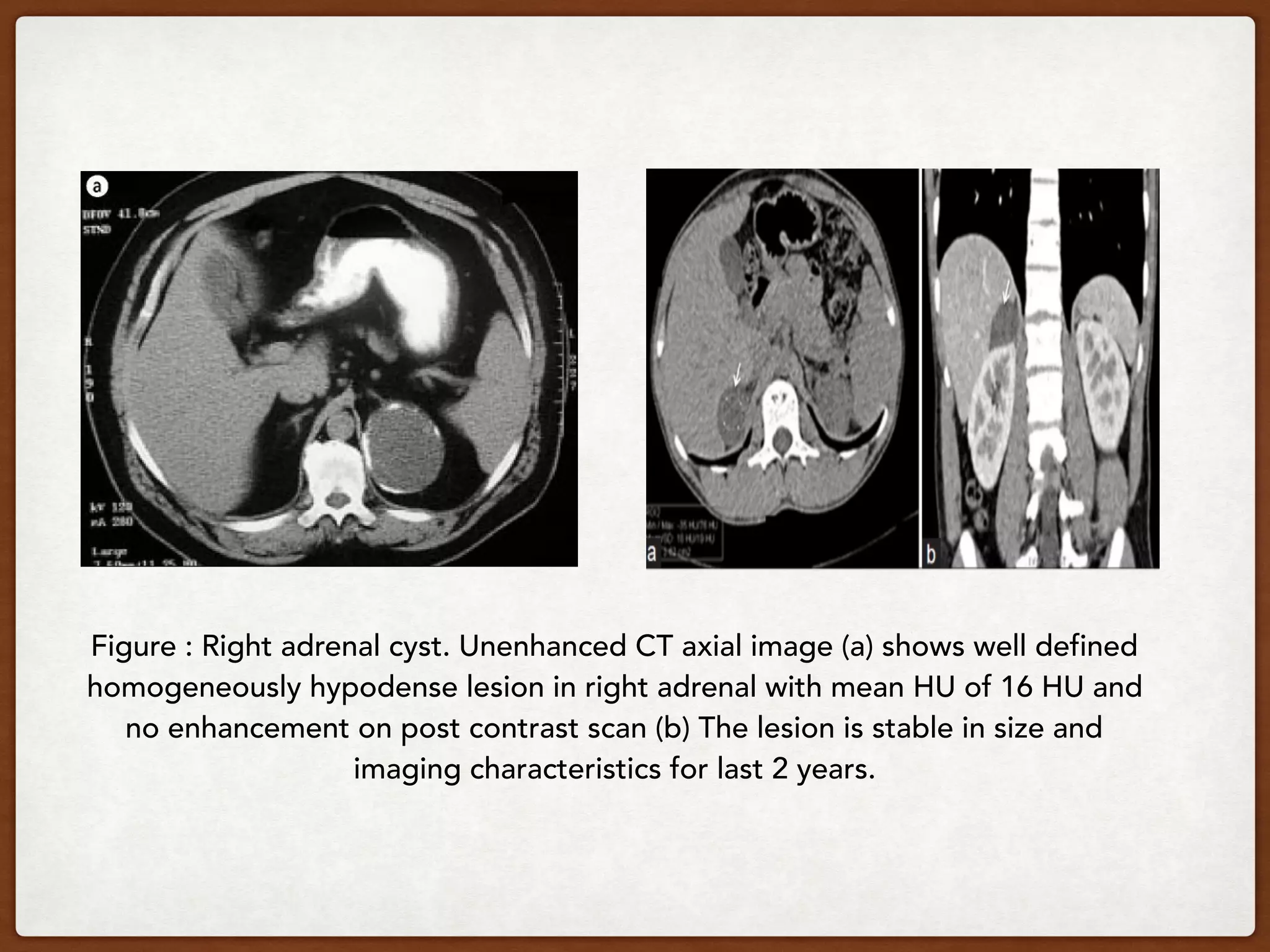 Figure : Right adrenal cyst. Unenhanced CT axial image (a) shows well defined
homogeneously hypodense lesion in right adrenal with mean HU of 16 HU and
no enhancement on post contrast scan (b) The lesion is stable in size and
imaging characteristics for last 2 years.
 