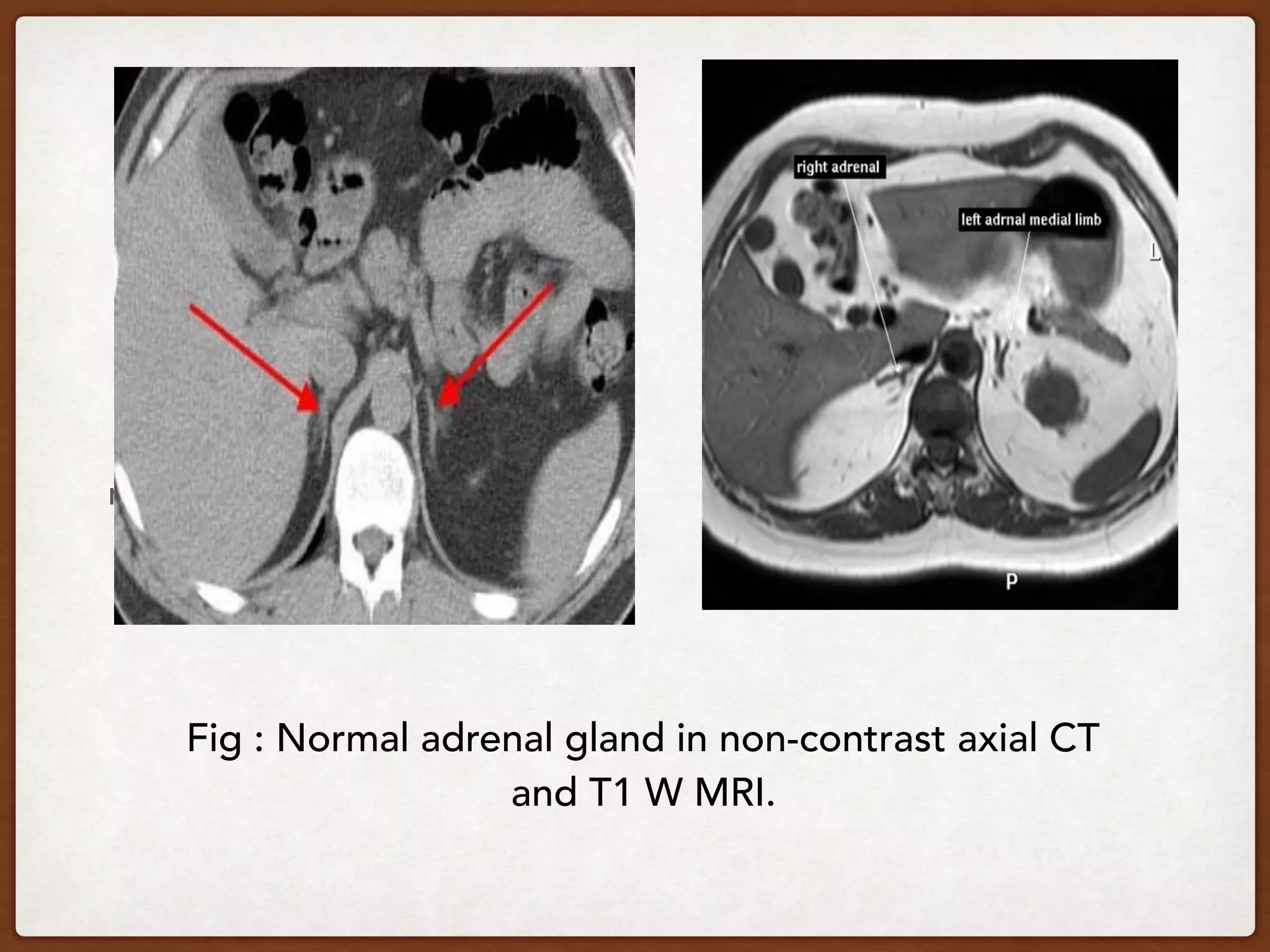 nnee
Fig : Normal adrenal gland in non-contrast axial CT
and T1 W MRI.
 