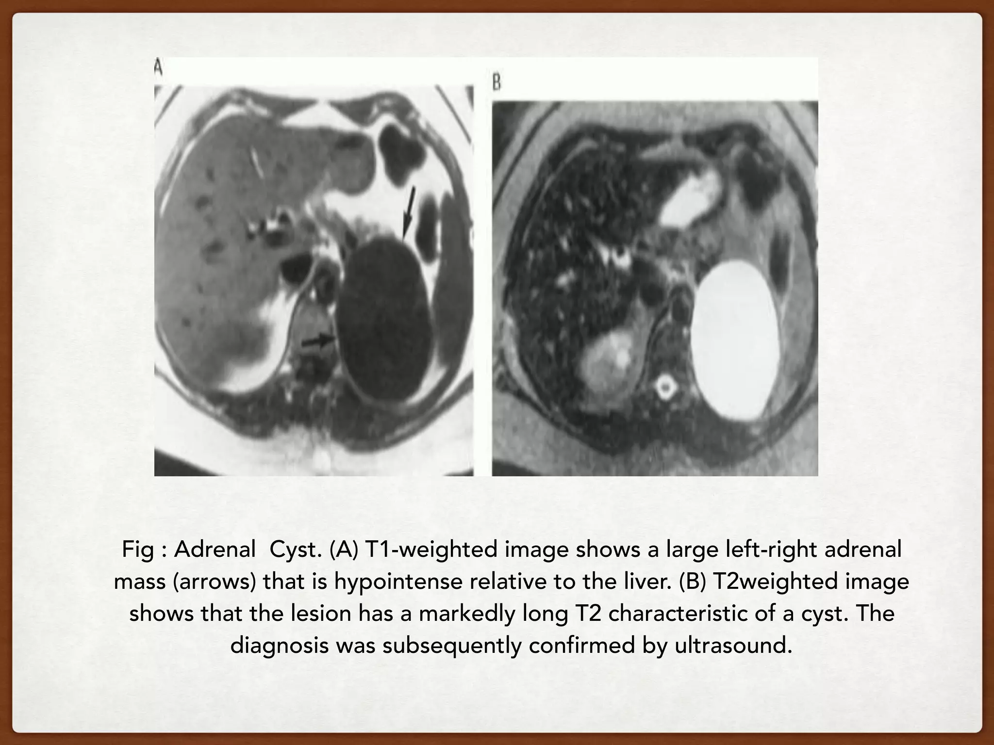 Fig : Adrenal Cyst. (A) T1-weighted image shows a large left-right adrenal
mass (arrows) that is hypointense relative to the liver. (B) T2weighted image
shows that the lesion has a markedly long T2 characteristic of a cyst. The
diagnosis was subsequently confirmed by ultrasound.
 