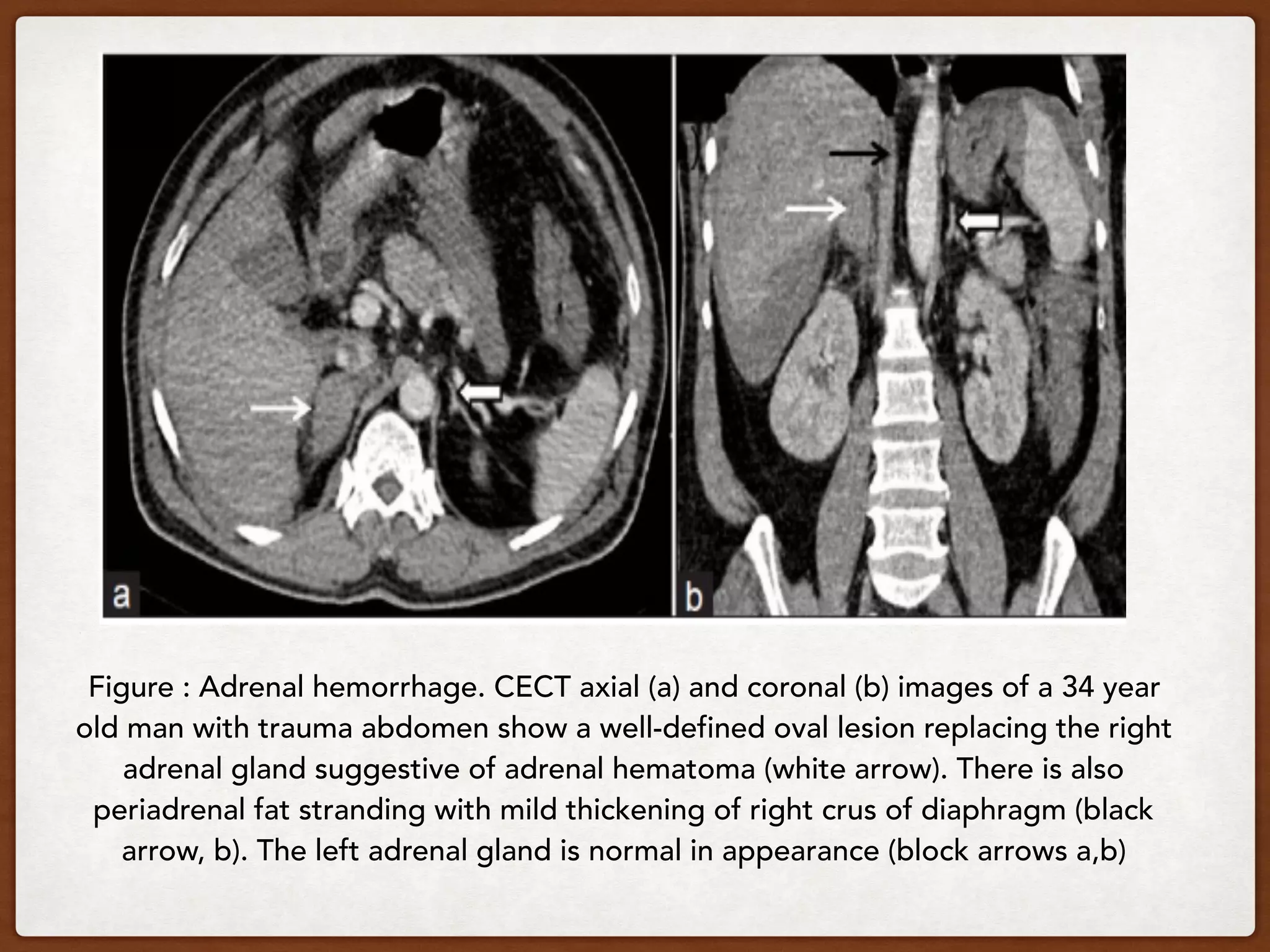 Figure : Adrenal hemorrhage. CECT axial (a) and coronal (b) images of a 34 year
old man with trauma abdomen show a well-defined oval lesion replacing the right
adrenal gland suggestive of adrenal hematoma (white arrow). There is also
periadrenal fat stranding with mild thickening of right crus of diaphragm (black
arrow, b). The left adrenal gland is normal in appearance (block arrows a,b)
 