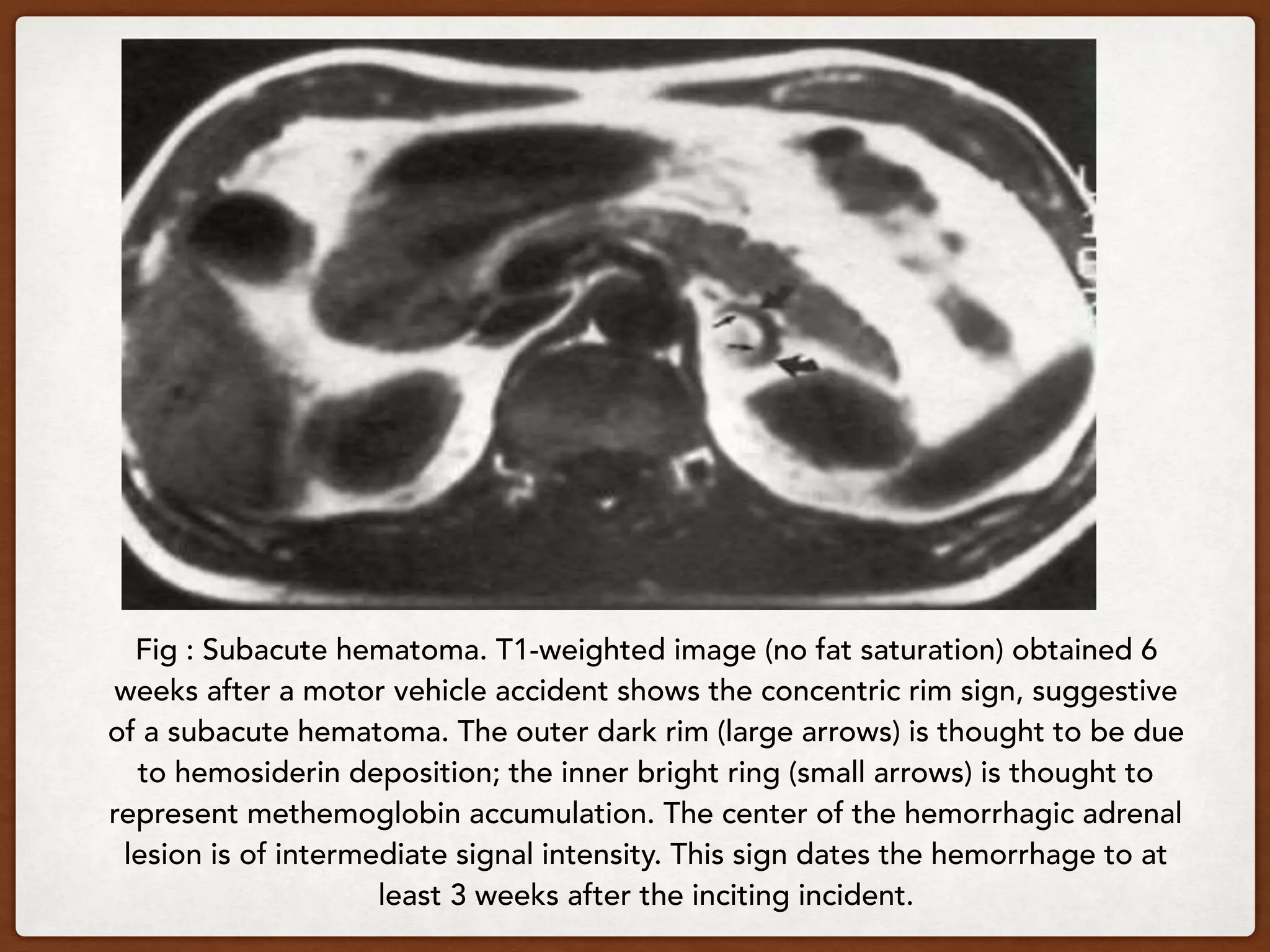 Fig : Subacute hematoma. T1-weighted image (no fat saturation) obtained 6
weeks after a motor vehicle accident shows the concentric rim sign, suggestive
of a subacute hematoma. The outer dark rim (large arrows) is thought to be due
to hemosiderin deposition; the inner bright ring (small arrows) is thought to
represent methemoglobin accumulation. The center of the hemorrhagic adrenal
lesion is of intermediate signal intensity. This sign dates the hemorrhage to at
least 3 weeks after the inciting incident.
 