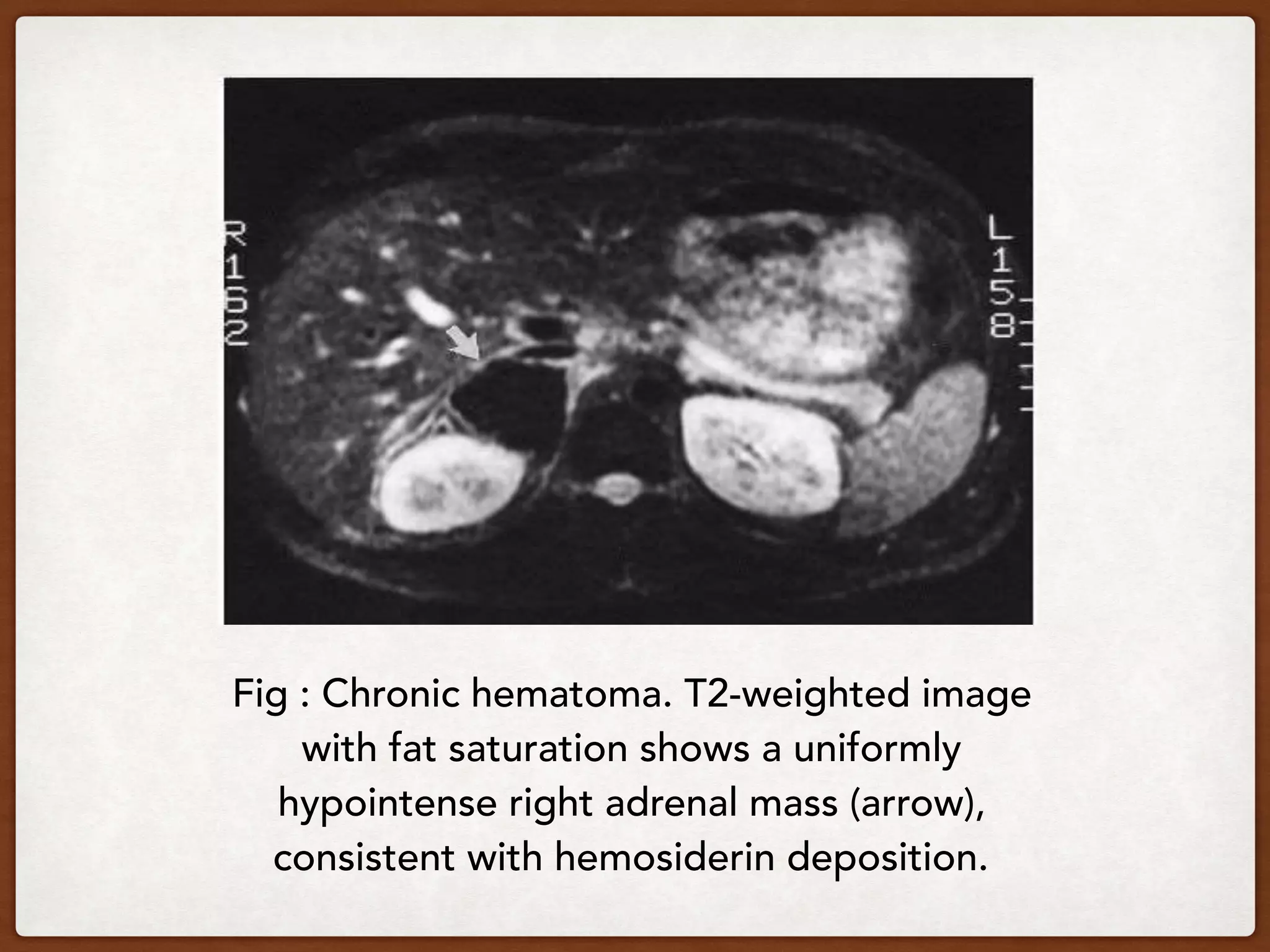 Fig : Chronic hematoma. T2-weighted image
with fat saturation shows a uniformly
hypointense right adrenal mass (arrow),
consistent with hemosiderin deposition.
 