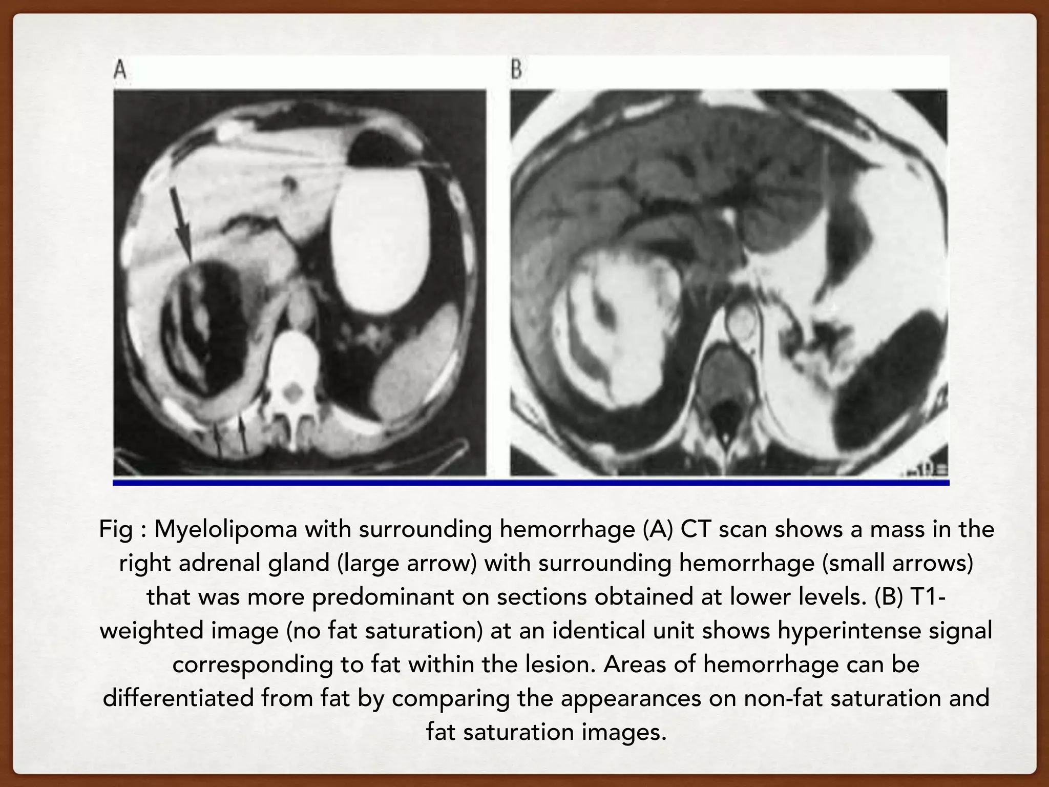 Fig : Myelolipoma with surrounding hemorrhage (A) CT scan shows a mass in the
right adrenal gland (large arrow) with surrounding hemorrhage (small arrows)
that was more predominant on sections obtained at lower levels. (B) T1-
weighted image (no fat saturation) at an identical unit shows hyperintense signal
corresponding to fat within the lesion. Areas of hemorrhage can be
differentiated from fat by comparing the appearances on non-fat saturation and
fat saturation images.
 