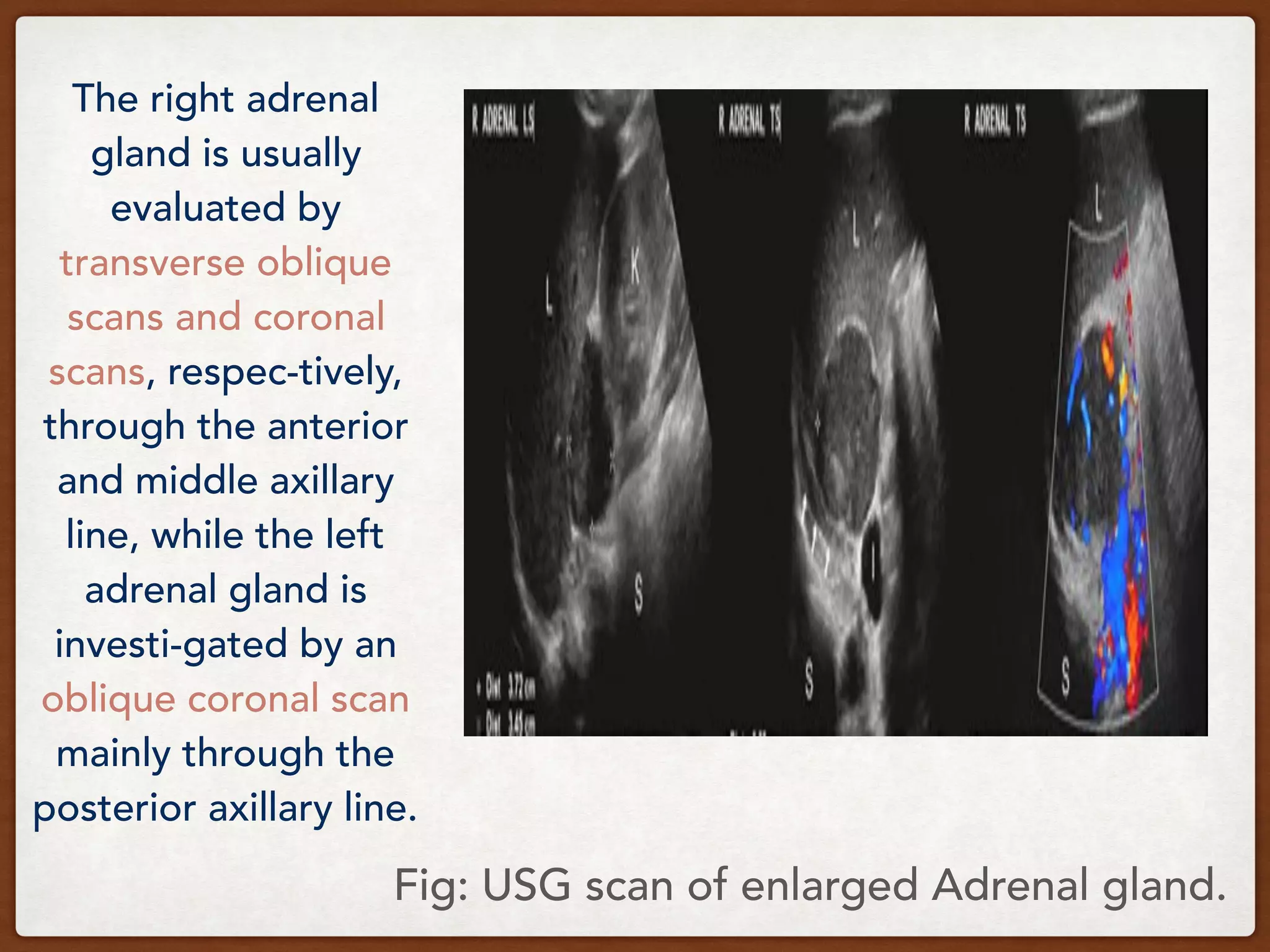 Fig: USG scan of enlarged Adrenal gland.
The right adrenal
gland is usually
evaluated by
transverse oblique
scans and coronal
scans, respec-tively,
through the anterior
and middle axillary
line, while the left
adrenal gland is
investi-gated by an
oblique coronal scan
mainly through the
posterior axillary line.
 