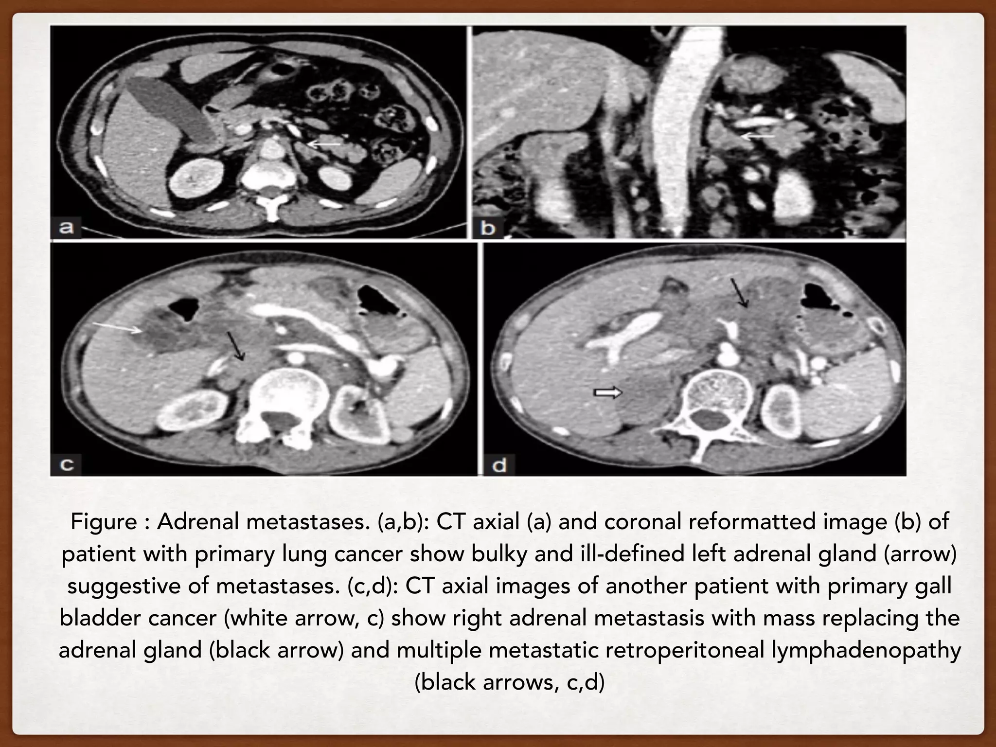 Figure : Adrenal metastases. (a,b): CT axial (a) and coronal reformatted image (b) of
patient with primary lung cancer show bulky and ill-defined left adrenal gland (arrow)
suggestive of metastases. (c,d): CT axial images of another patient with primary gall
bladder cancer (white arrow, c) show right adrenal metastasis with mass replacing the
adrenal gland (black arrow) and multiple metastatic retroperitoneal lymphadenopathy
(black arrows, c,d)
 