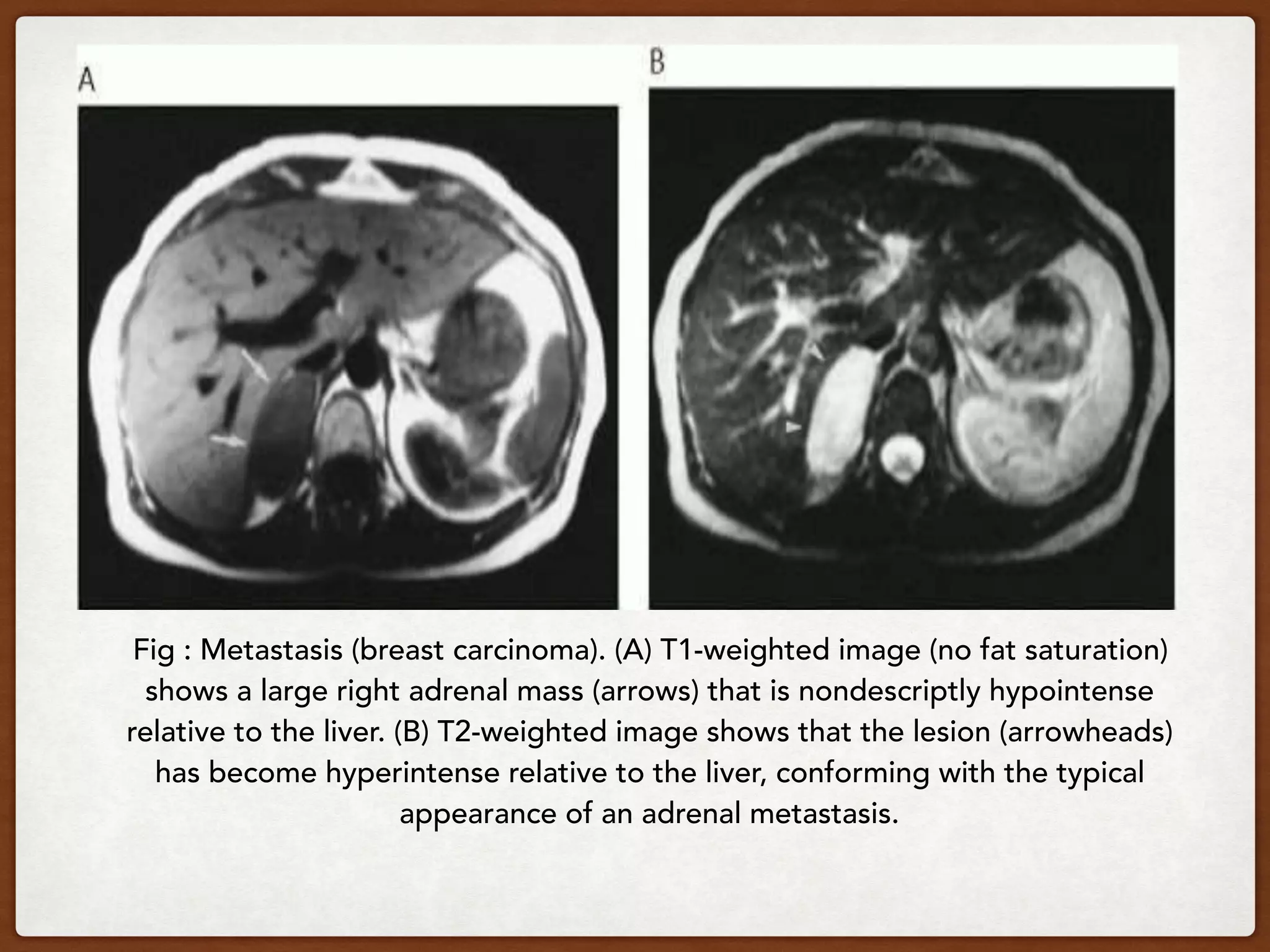 Fig : Metastasis (breast carcinoma). (A) T1-weighted image (no fat saturation)
shows a large right adrenal mass (arrows) that is nondescriptly hypointense
relative to the liver. (B) T2-weighted image shows that the lesion (arrowheads)
has become hyperintense relative to the liver, conforming with the typical
appearance of an adrenal metastasis.
 