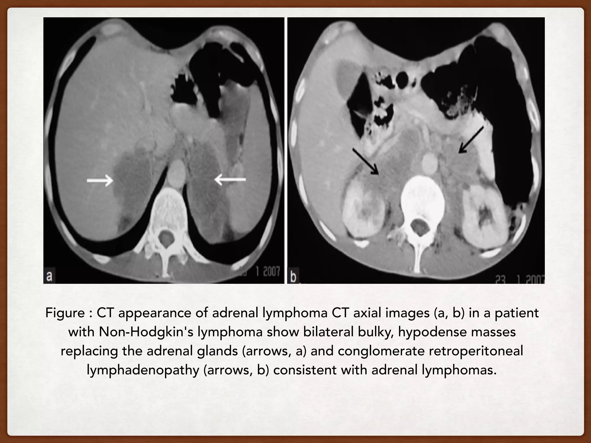 Figure : CT appearance of adrenal lymphoma CT axial images (a, b) in a patient
with Non-Hodgkin's lymphoma show bilateral bulky, hypodense masses
replacing the adrenal glands (arrows, a) and conglomerate retroperitoneal
lymphadenopathy (arrows, b) consistent with adrenal lymphomas.
 