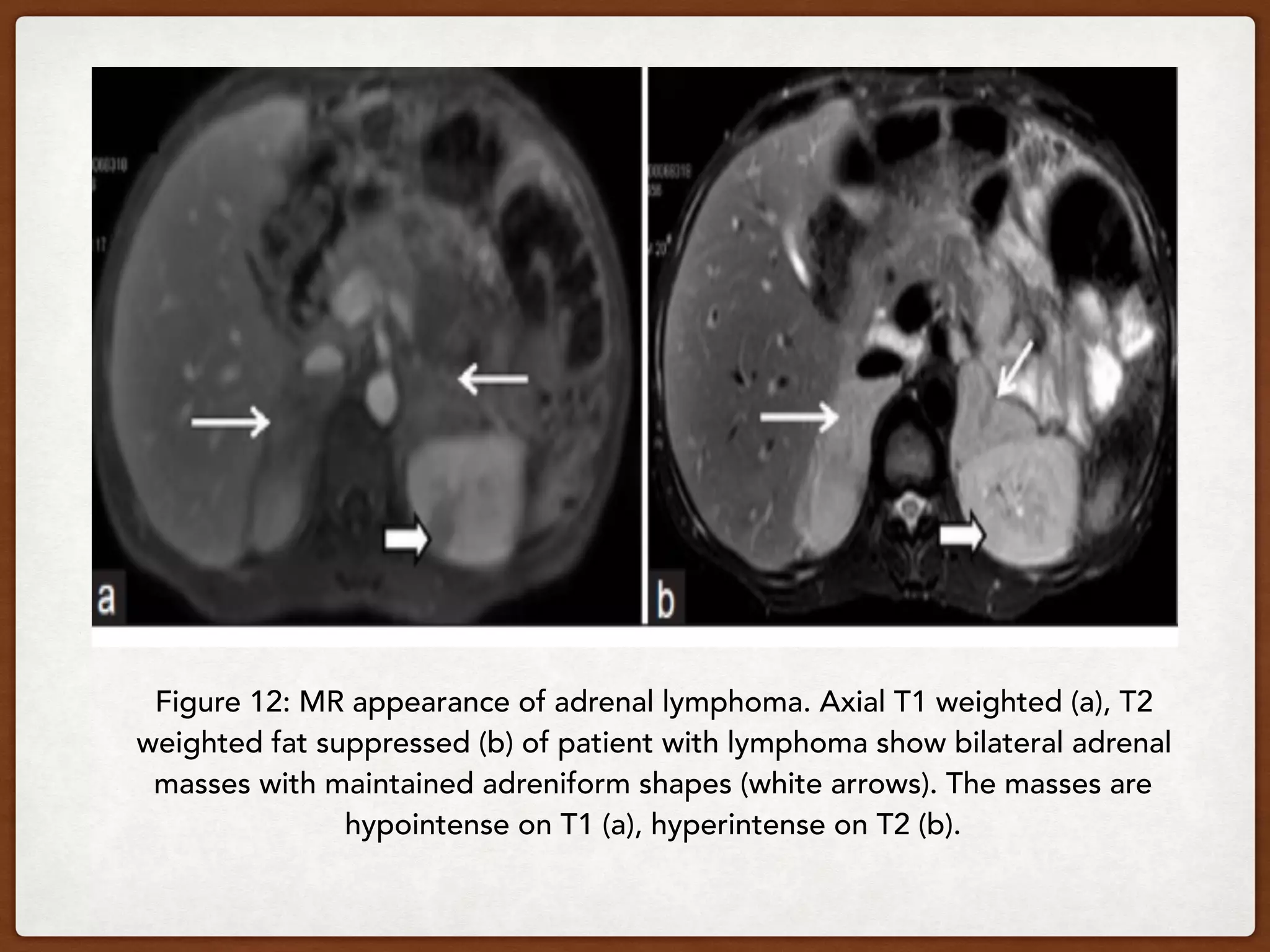 Figure 12: MR appearance of adrenal lymphoma. Axial T1 weighted (a), T2
weighted fat suppressed (b) of patient with lymphoma show bilateral adrenal
masses with maintained adreniform shapes (white arrows). The masses are
hypointense on T1 (a), hyperintense on T2 (b).
 