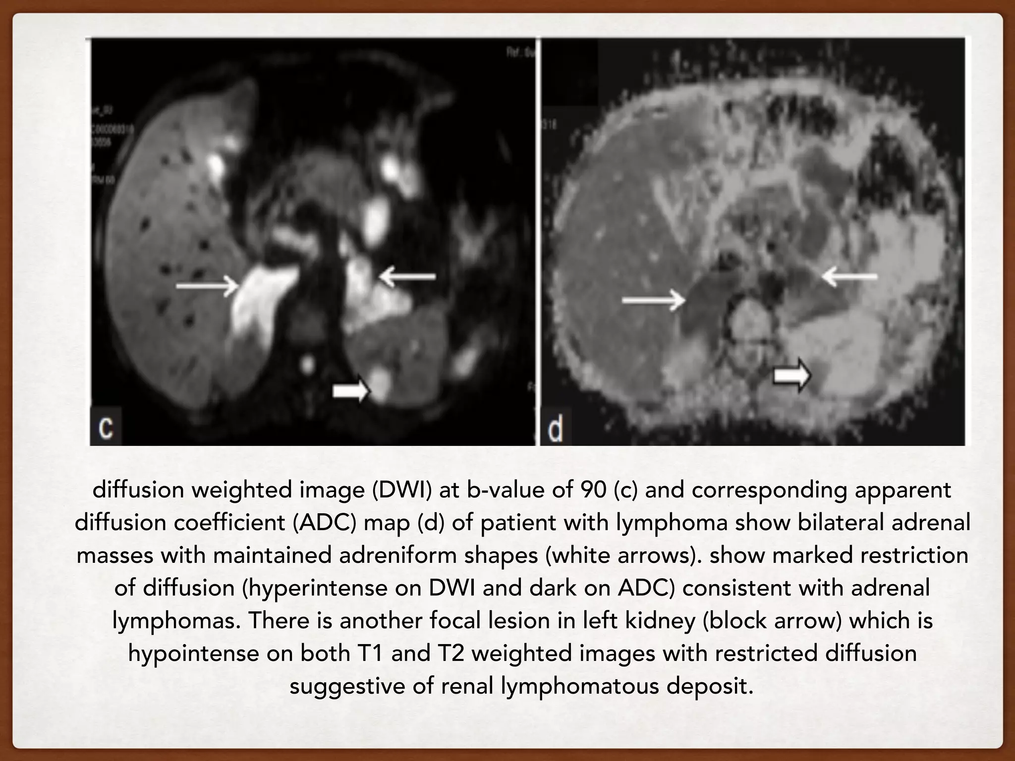 diffusion weighted image (DWI) at b-value of 90 (c) and corresponding apparent
diffusion coefficient (ADC) map (d) of patient with lymphoma show bilateral adrenal
masses with maintained adreniform shapes (white arrows). show marked restriction
of diffusion (hyperintense on DWI and dark on ADC) consistent with adrenal
lymphomas. There is another focal lesion in left kidney (block arrow) which is
hypointense on both T1 and T2 weighted images with restricted diffusion
suggestive of renal lymphomatous deposit.
 