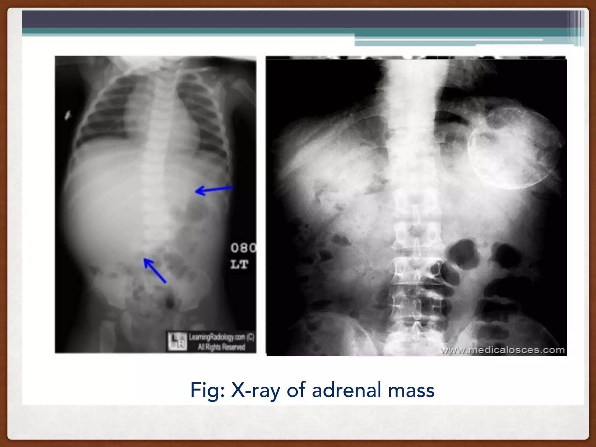 Fig: X-ray of adrenal mass
 