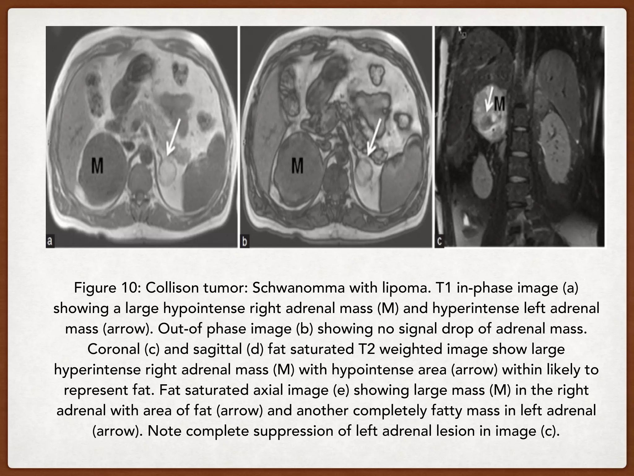Figure 10: Collison tumor: Schwanomma with lipoma. T1 in-phase image (a)
showing a large hypointense right adrenal mass (M) and hyperintense left adrenal
mass (arrow). Out-of phase image (b) showing no signal drop of adrenal mass.
Coronal (c) and sagittal (d) fat saturated T2 weighted image show large
hyperintense right adrenal mass (M) with hypointense area (arrow) within likely to
represent fat. Fat saturated axial image (e) showing large mass (M) in the right
adrenal with area of fat (arrow) and another completely fatty mass in left adrenal
(arrow). Note complete suppression of left adrenal lesion in image (c).
 