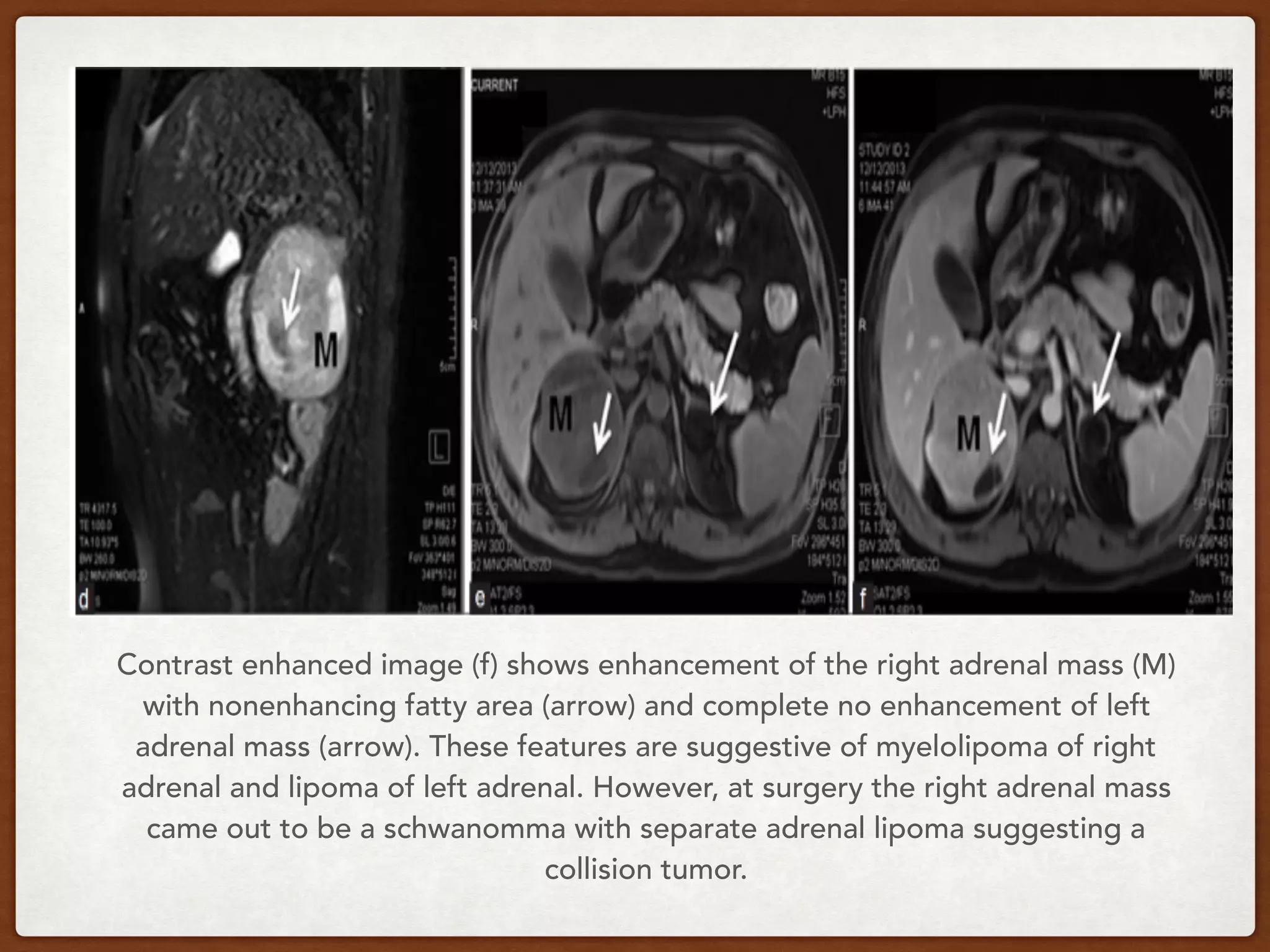 Contrast enhanced image (f) shows enhancement of the right adrenal mass (M)
with nonenhancing fatty area (arrow) and complete no enhancement of left
adrenal mass (arrow). These features are suggestive of myelolipoma of right
adrenal and lipoma of left adrenal. However, at surgery the right adrenal mass
came out to be a schwanomma with separate adrenal lipoma suggesting a
collision tumor. 
 