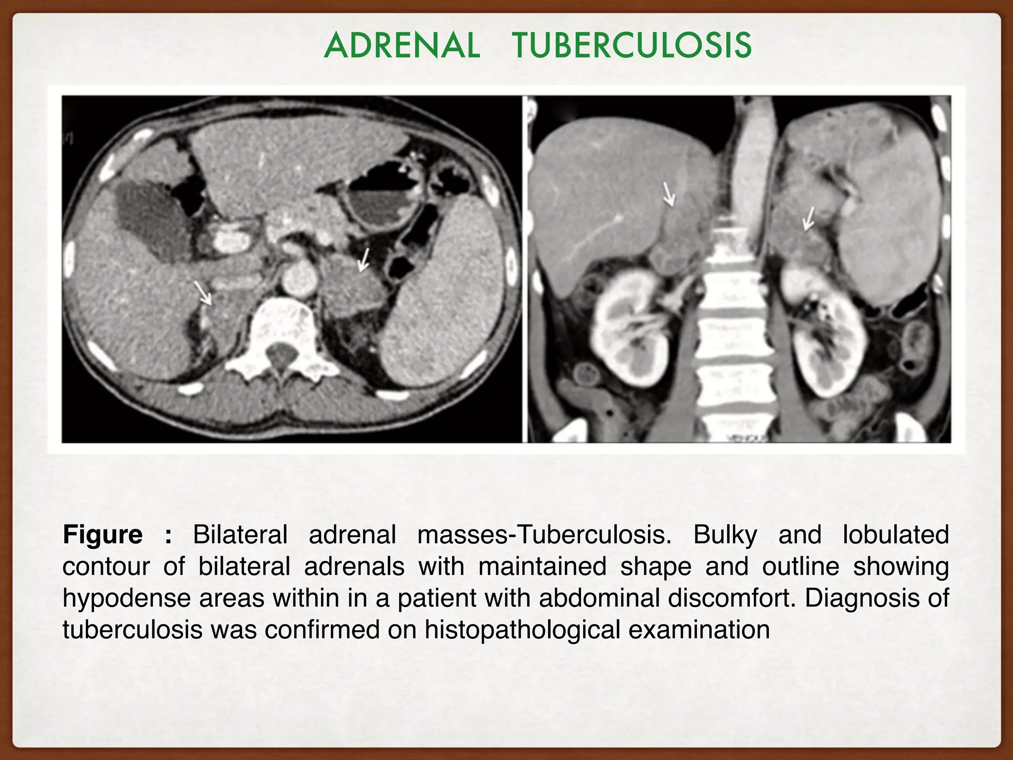 Figure : Bilateral adrenal masses-Tuberculosis. Bulky and lobulated
contour of bilateral adrenals with maintained shape and outline showing
hypodense areas within in a patient with abdominal discomfort. Diagnosis of
tuberculosis was conﬁrmed on histopathological examination
ADRENAL TUBERCULOSIS
 