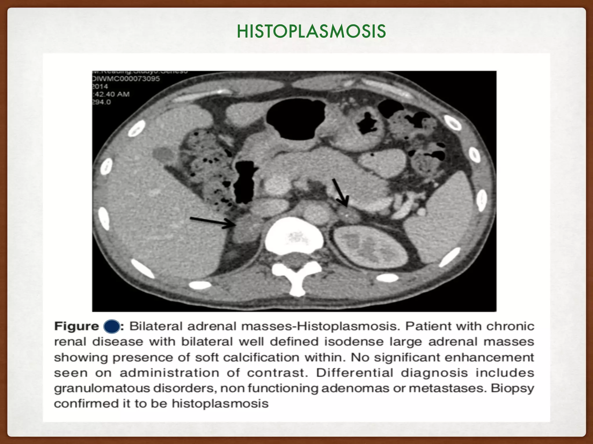 HISTOPLASMOSIS
 