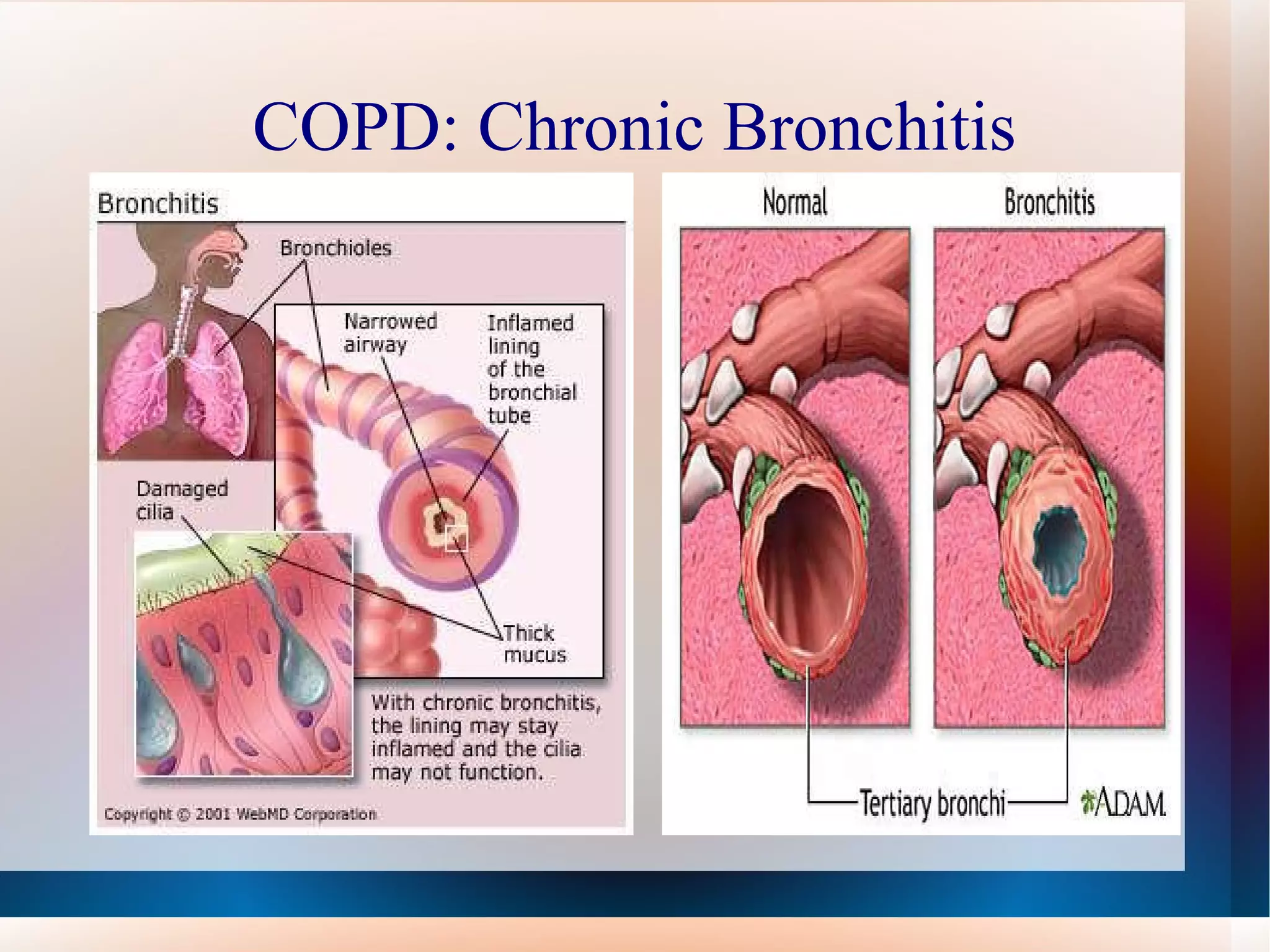 COPD: Chronic Bronchitis 