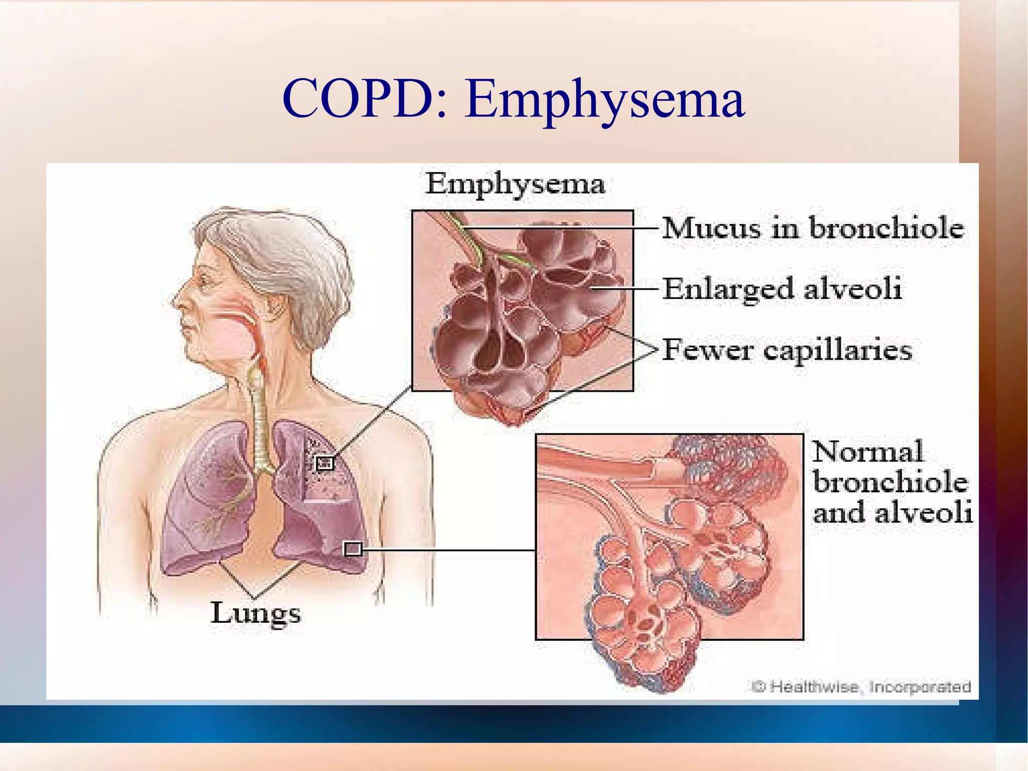 COPD: Emphysema 