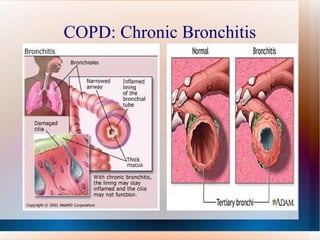 COPD: Chronic Bronchitis 