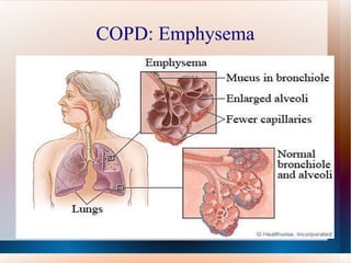 COPD: Emphysema 