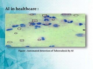 AI in healthcare :
Figure : Automated detection of Tuberculosis by AI
 