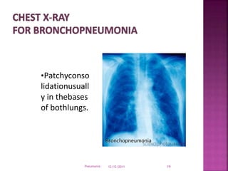 Pneumoniawhichdevelopsinanotherwisehealthy
personoutsideofhospitalorhavebeeninhospitalfor
lessthan48hrs
Pneumonia 12/12/20...