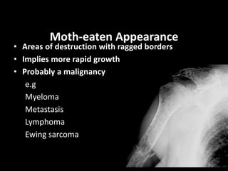 Moth-eaten Appearance
• Areas of destruction with ragged borders
• Implies more rapid growth
• Probably a malignancy
e.g
Myeloma
Metastasis
Lymphoma
Ewing sarcoma
 
