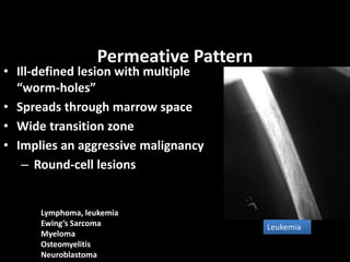 Permeative Pattern
• Ill-defined lesion with multiple
“worm-holes”
• Spreads through marrow space
• Wide transition zone
• Implies an aggressive malignancy
– Round-cell lesions
Leukemia
Lymphoma, leukemia
Ewing’s Sarcoma
Myeloma
Osteomyelitis
Neuroblastoma
 