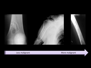 Less malignant More malignant
 
