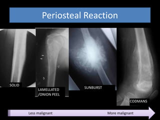 SUNBURST
CODMANS
LAMELLATED
/ONION PEEL
Periosteal Reaction
SOLID
Less malignant More malignant
 