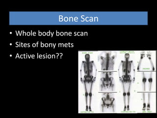 Bone Scan
• Whole body bone scan
• Sites of bony mets
• Active lesion??
 