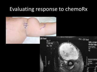 Evaluating response to chemoRx
 