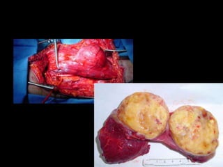 Lecture 1: Presentation and staging msk tumour