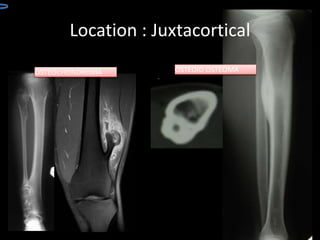 OSTEOID OSTEOMAOSTEOCHONDROMA
Location : Juxtacortical
 
