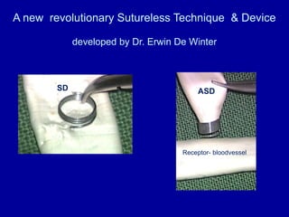 A new  revolutionary Sutureless Technique  & Device  developed by Dr. Erwin De Winter  ASD  SD   Receptor- bloodvessel 