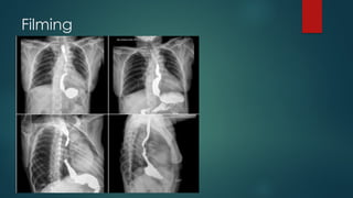 Presentation on Barium swallow through different sources | PPTX
