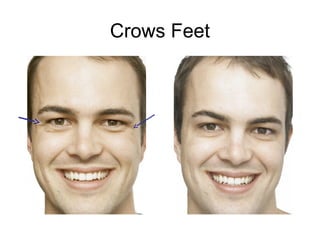 Crows Feet 
 