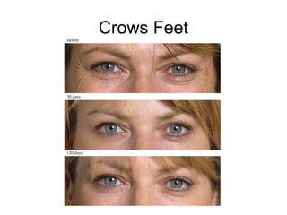 Crows Feet 
 