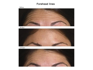 Forehead lines 
 