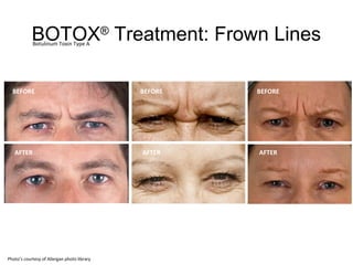 BOTOX® Treatment: Frown Lines 
Botulinum Toxin Type A 
BEFORE 
AFTER 
BEFORE 
AFTER 
BEFORE 
AFTER 
Photo’s courtesy of Allergan photo library 
 