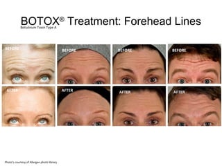BOTOX® Treatment: Forehead Lines 
BEFORE 
AFTER 
BEFORE 
AFTER 
BEFORE 
AFTER 
BEFORE 
AFTER 
Botulinum Toxin Type A 
Photo’s courtesy of Allergan photo library 
 