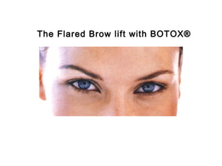 The Flared Brow lift with BOTOX® 
 