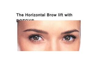 The Horizontal Brow lift with 
BOTOX® 
 