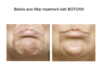 Before and After treatment with BOTOX® 
 