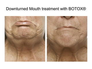 Downturned Mouth treatment with BOTOX® 
 