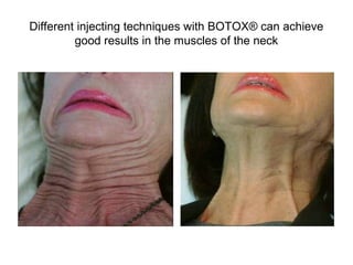 Different injecting techniques with BOTOX® can achieve 
good results in the muscles of the neck 
 