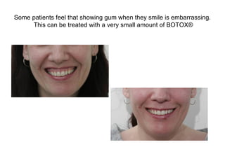 Some patients feel that showing gum when they smile is embarrassing. 
This can be treated with a very small amount of BOTOX® 
 
