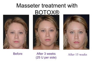 Masseter treatment with 
BOTOX® 
Before After 3 weeks 
(25 U per side) 
After 15 weeks 
 