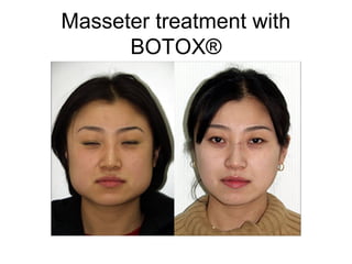 Masseter treatment with 
BOTOX® 
 